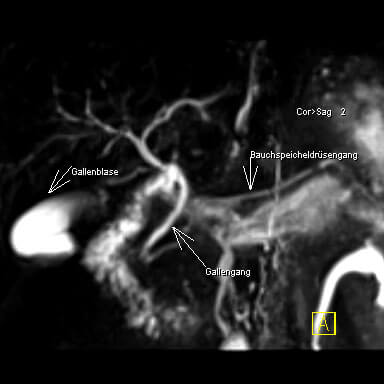 Abbildung der Gallenwege und des Bauchspeicheldrüsengangs