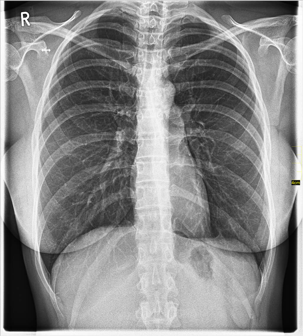 Thorax-Aufnahme