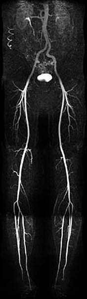MRA der Beingefäße