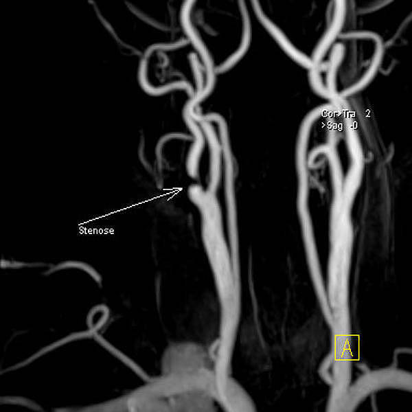 Verengung der Halsschlagader