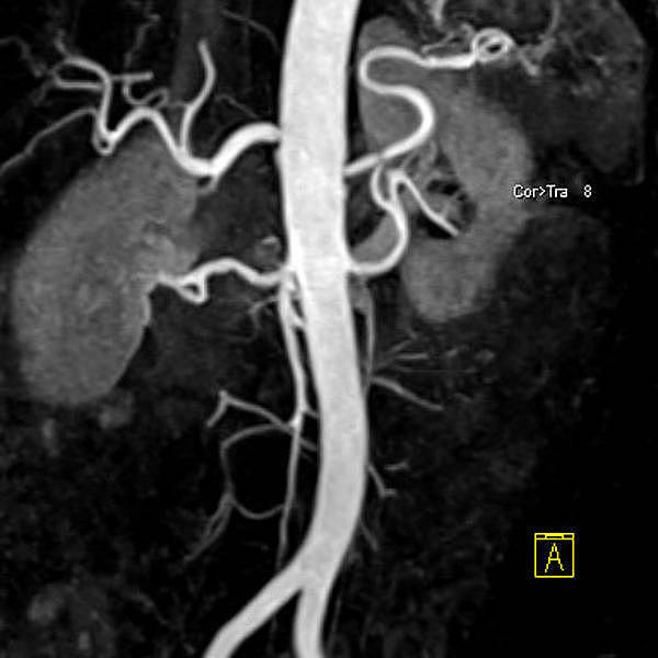 MRA der Nierengefäße
