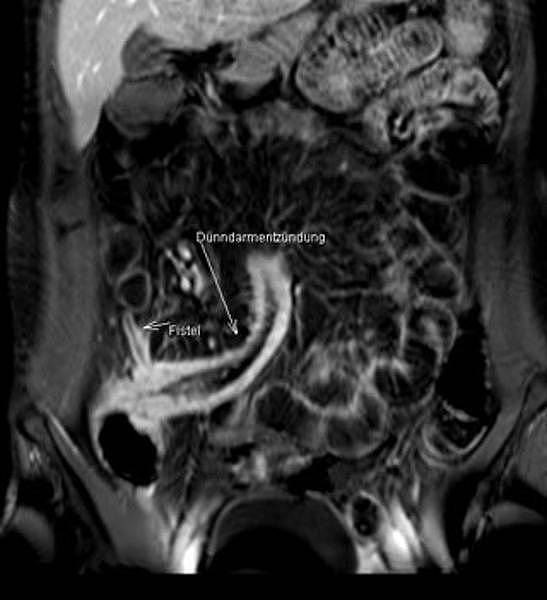 Hydro-MRT: Flüssigkeit im Darm als "Kontrastmittel"