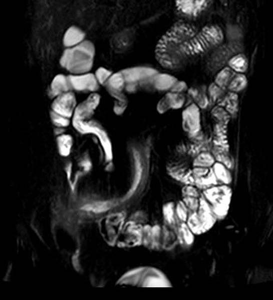 Entzündlich verdickte Darmwand und Fistel bei Crohn-Erkrankung