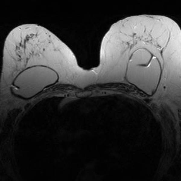 Darstellung von Implantaten (Silikon) im MRT