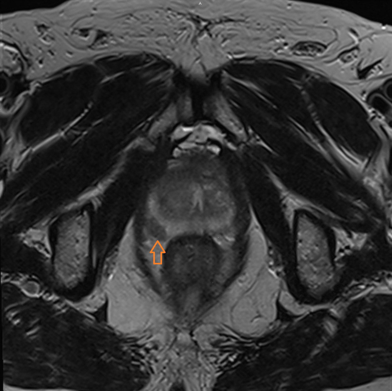 MRT der Prostata - Darstellung eines Prostata-Carcinoms